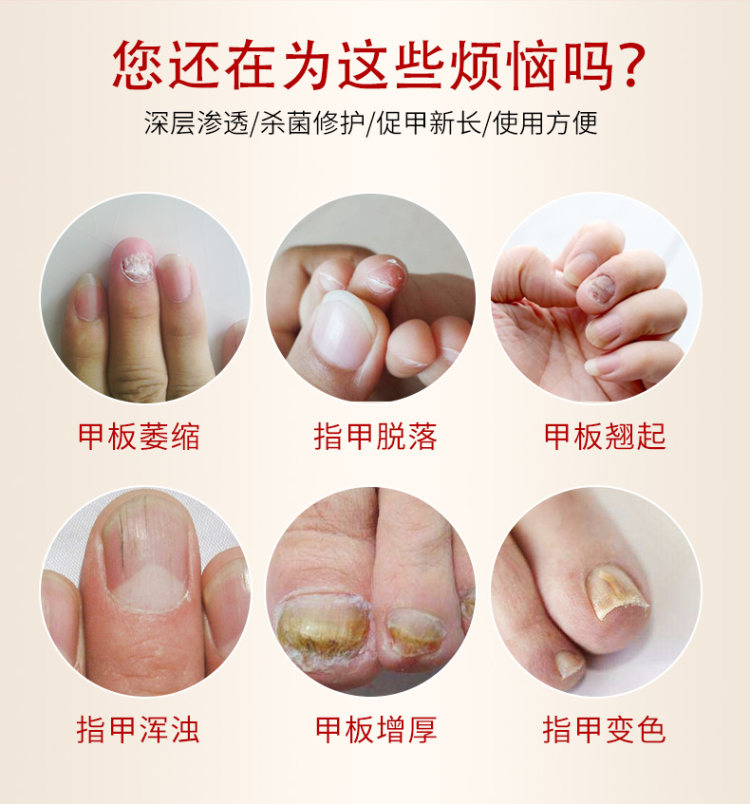 修正 去灰指甲抑菌液  去除增厚灰甲 图3