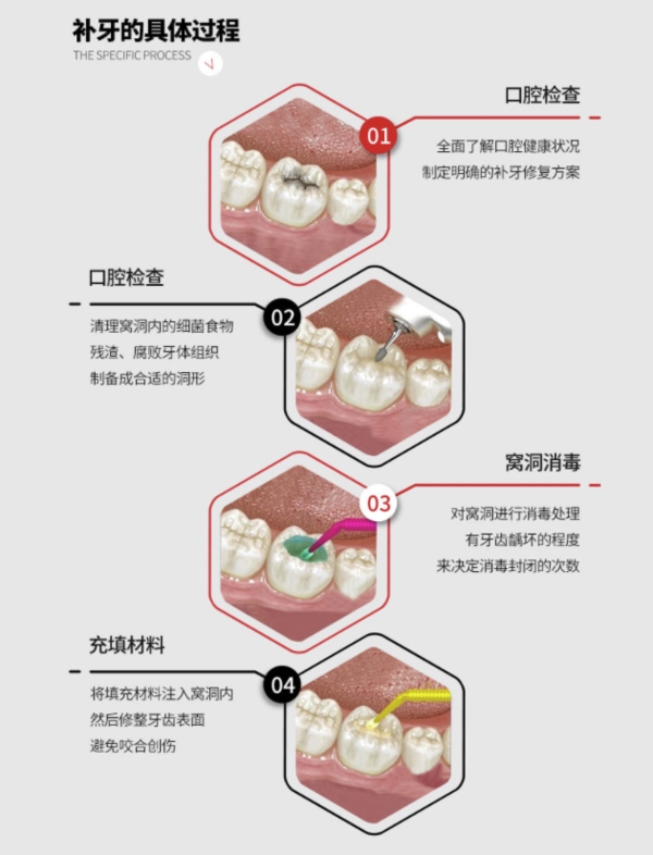 牙博士口腔 3M Z350进口光固化复合树脂补牙 图2