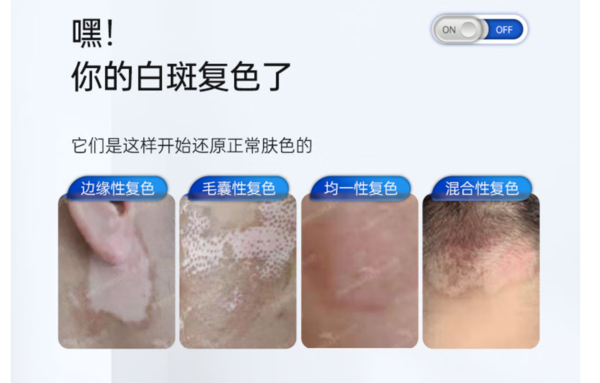 半岛 308白癜风光疗仪UV50 PLUS 【加强款】针对难点白斑四肢