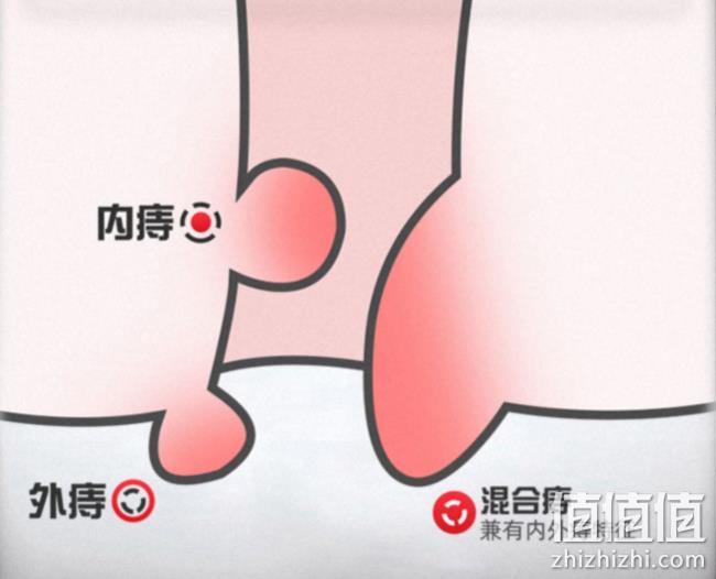 贴肚脐、1-2贴解除轻度痔疮：一盒4贴  荣昌肛泰 痔疮贴肚脐贴 券后25元包邮（上次30元） 值值值-买手聚集的地方