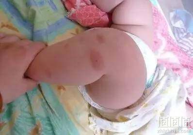炎热夏天必须注意宝宝防蚊防晒防痱