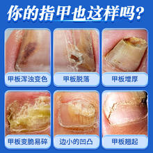 88VIP会员：孔艾堂 北京同仁堂灰指甲甲沟炎专用药水特效正品钳指甲刀冰醋酸抗抑菌液