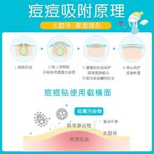 88VIP会员：护妍天使 DermaAngel 痘痘贴隐形遮瑕吸脓修护消炎祛痘贴人工皮90贴详情领红包
