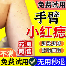 红痣血管痣专用凝胶可搭血管瘤去除修复成人儿童婴儿身上头上长红痣樱桃草莓状红血丝皮肤外用专用凝胶 单盒体验装26.5元 (券后省6)